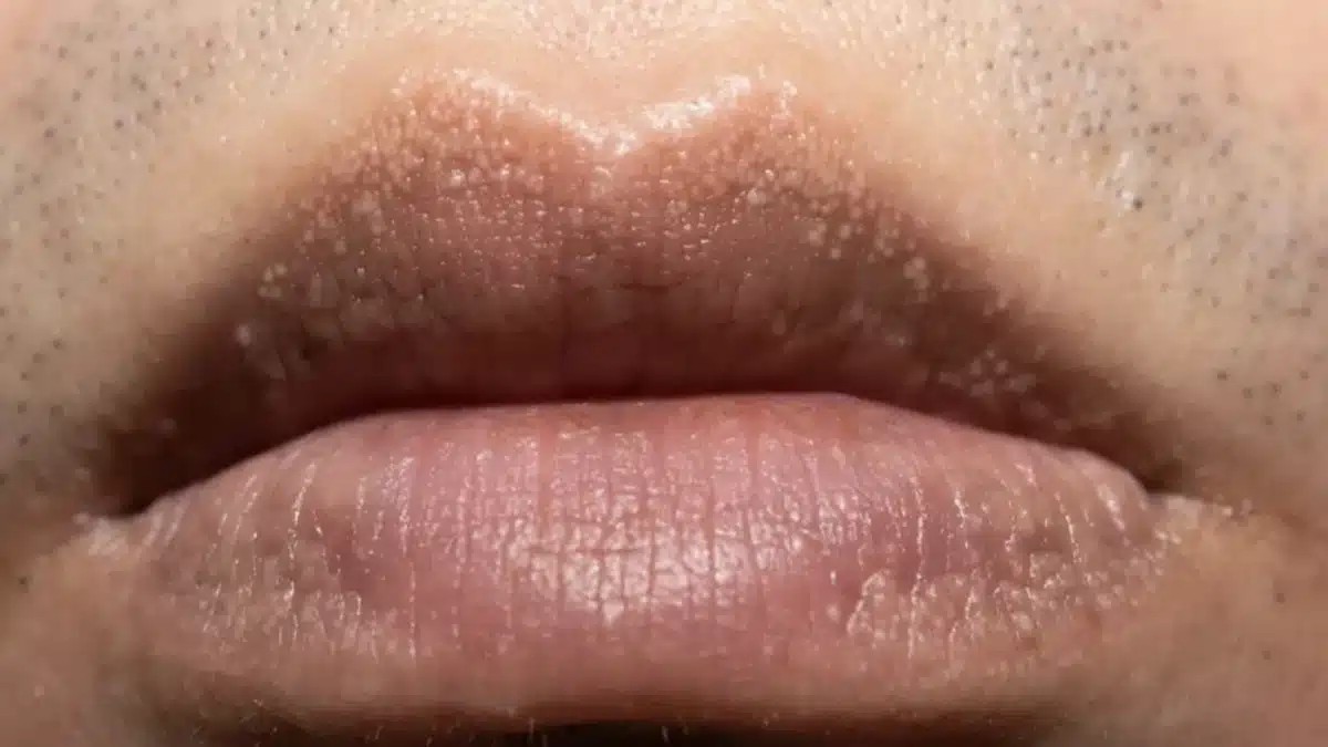 Não coça, não dói, mas está aí: o que são essas bolinhas?